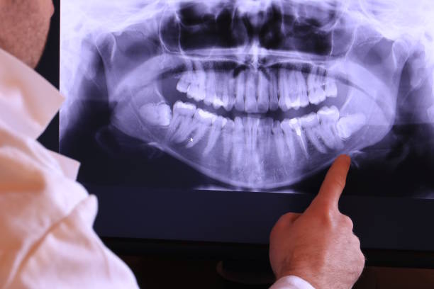 Best Emergency Wisdom Tooth Extraction in Westway, TX